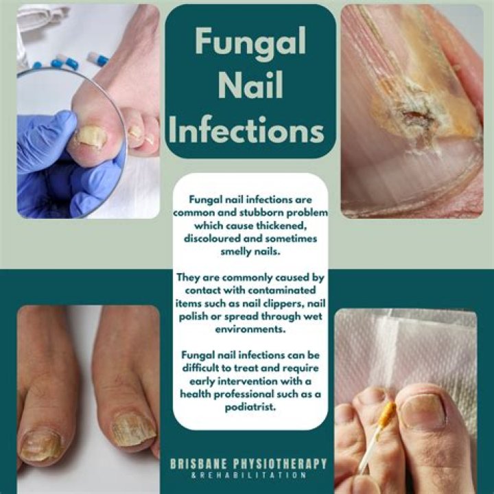Can nail clippers spread fungus?