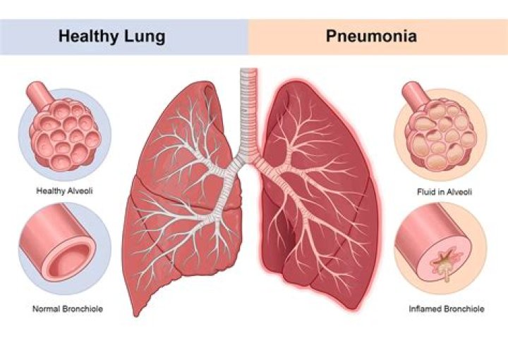 Can pneumonia go away without antibiotics?