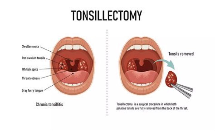 Can you talk after tonsil removal?