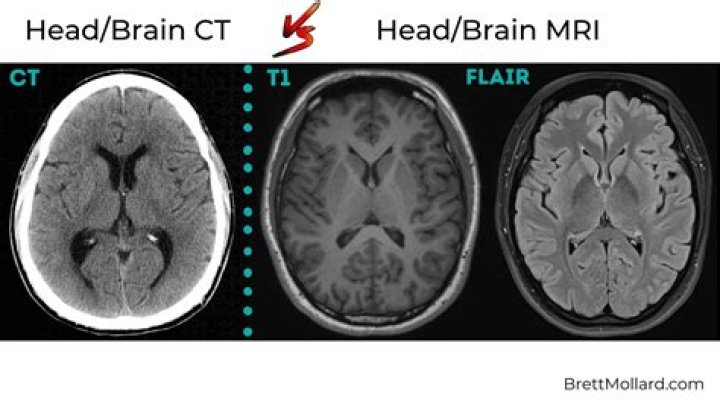 What can an MRI of the brain show that a CT scan cant?