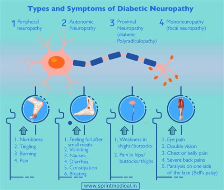 What is Stage 3 neuropathy?