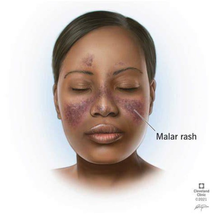Which one is worse MS or lupus?