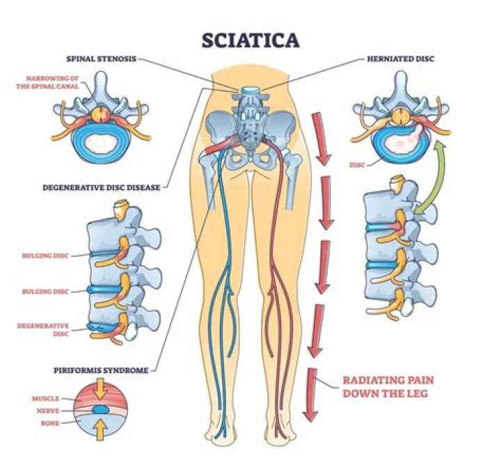 Why is sciatica worse in the morning?